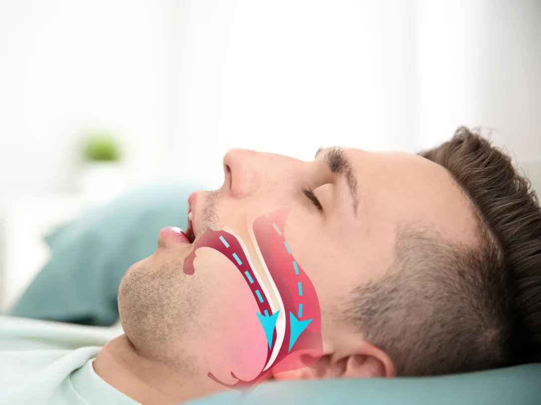 Tackling Sleep Apnea